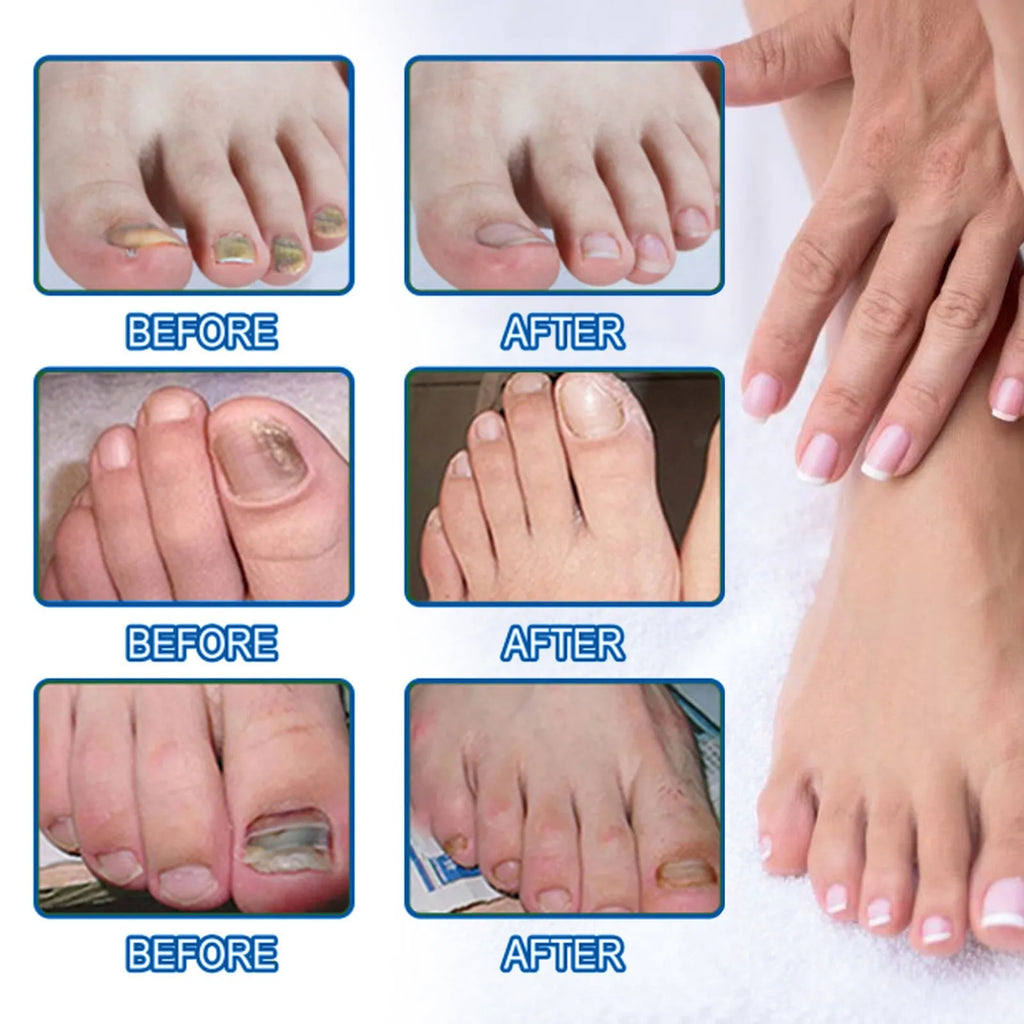 Nail repair adhesive bandage patches measuring 6.1 x 3.5 cm with glycerin, tea tree oil, and vitamin E ingredients