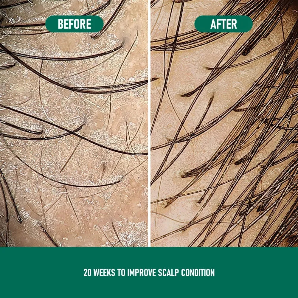 CH004 Minoxidil Anti-Hair Loss Mousse for scalp hair regrowth, non-greasy foam format