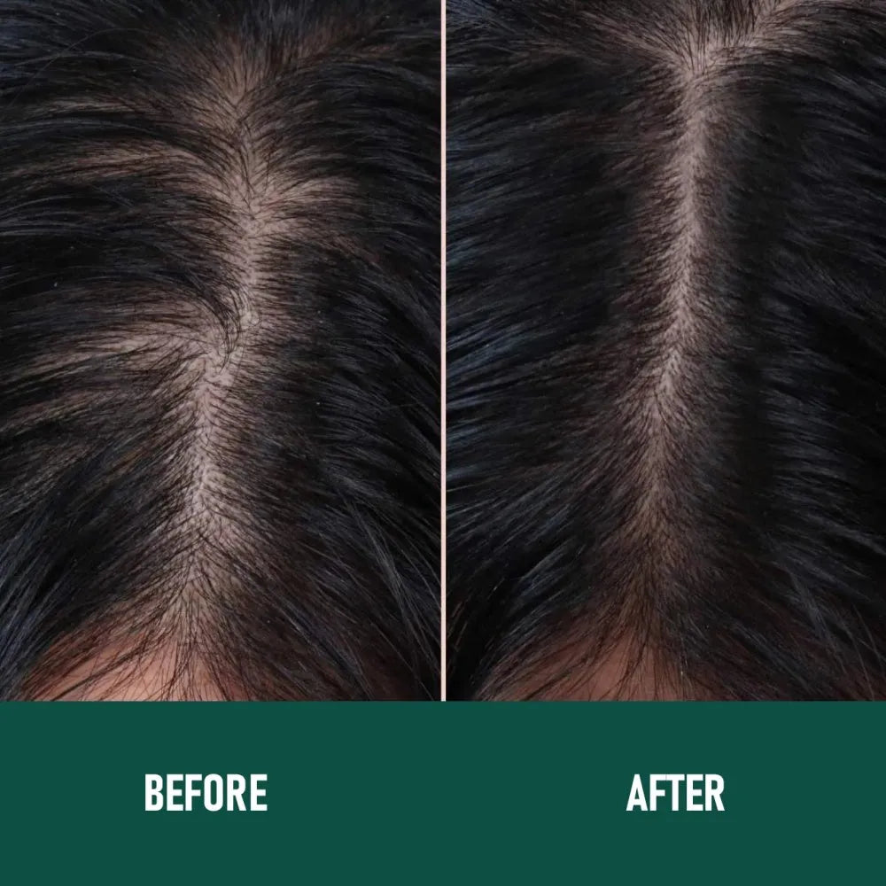 CH004 Minoxidil Anti-Hair Loss Mousse for scalp hair regrowth, non-greasy foam format