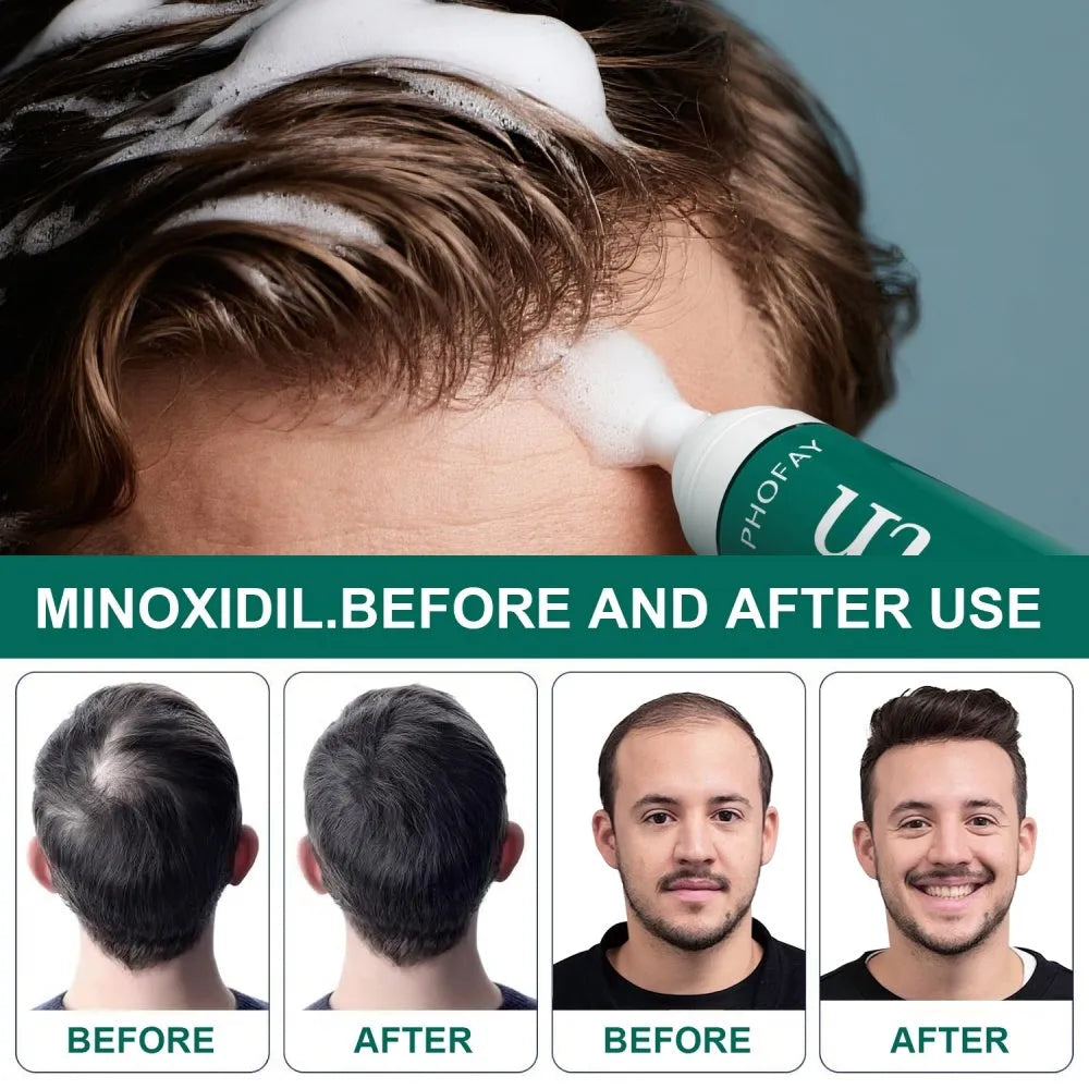 CH004 Minoxidil Anti-Hair Loss Mousse for scalp hair regrowth, non-greasy foam format