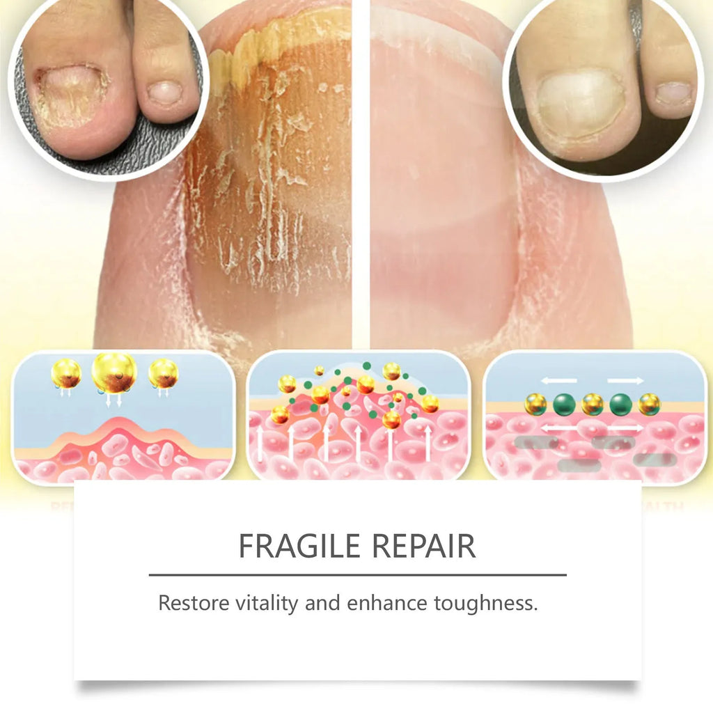 50ml nail fungus care solution bottle with bee venom and peppermint oil ingredients list